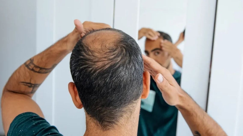 Cần chăm sóc da đầu đúng cách để hỗ trợ điều trị hói hiệu quả