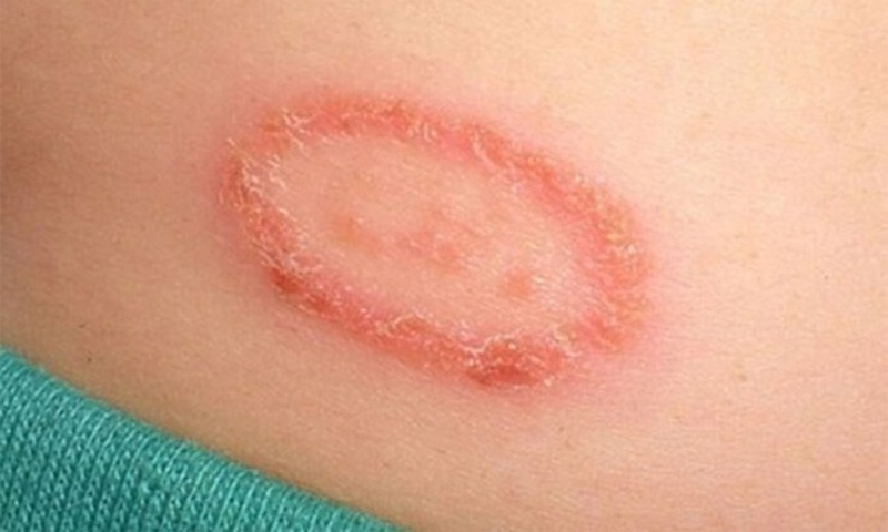 3 cách trị lác đồng tiền đơn giản và hiệu quả nhất 1