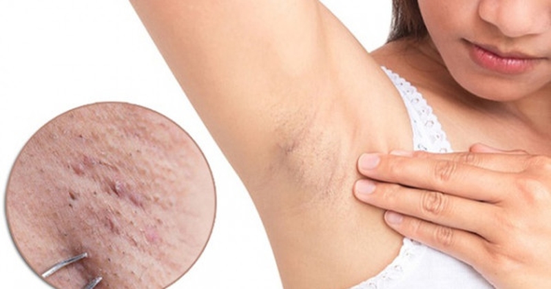 Cách trị lông mọc ngược ở chân cực đơn giản và hiệu quả 2