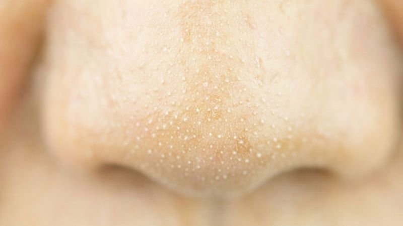 cách trị mụn cám hiệu quả không phải ai cũng biết 1