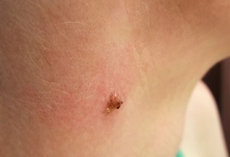 Cách trị mụn cóc bằng trái nhàu đơn giản dễ làm 1