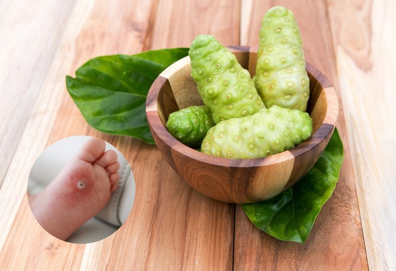 Cách trị mụn cóc bằng trái nhàu đơn giản dễ làm 2