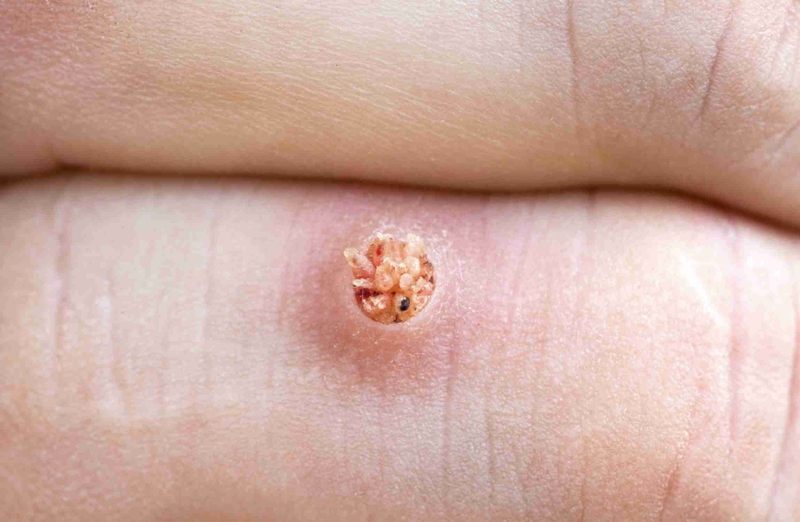 Cách trị mụn cóc tại nhà 1