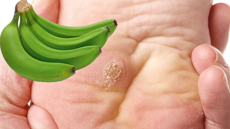 Cách trị mụn cóc tại nhà 4