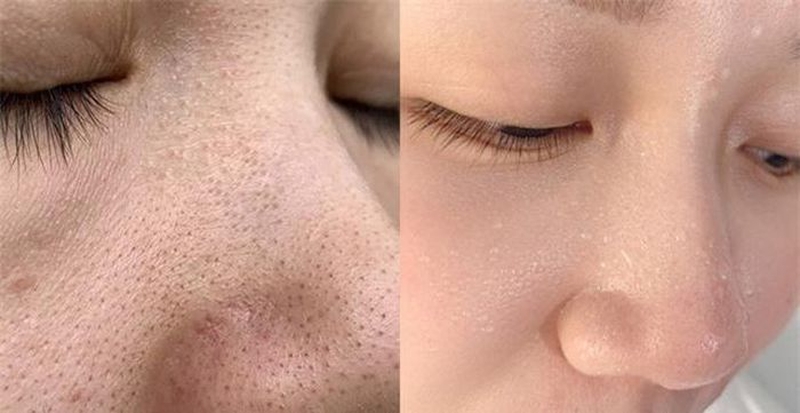 Mụn đầu đen nguyên nhân khiến làn da kém sắc