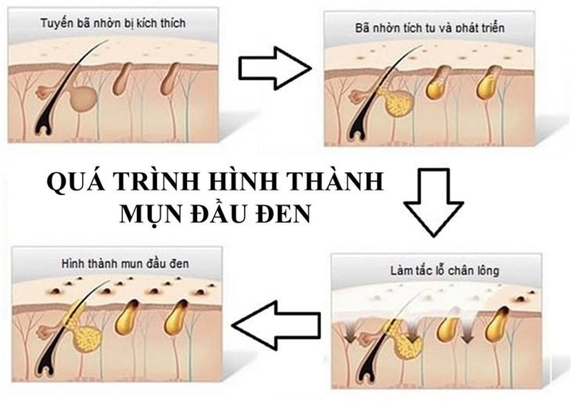 Cơ chế hình thành mụn đầu đen