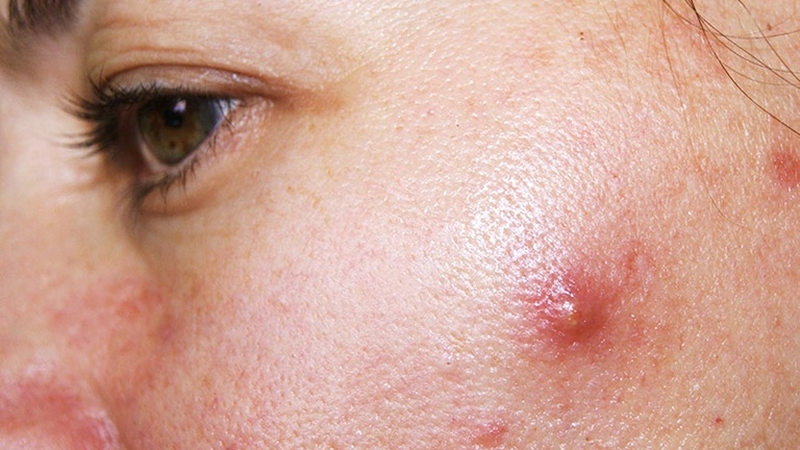 Cách trị mụn nhọt ở mặt và những lưu ý khi điều trị tại nhà 1