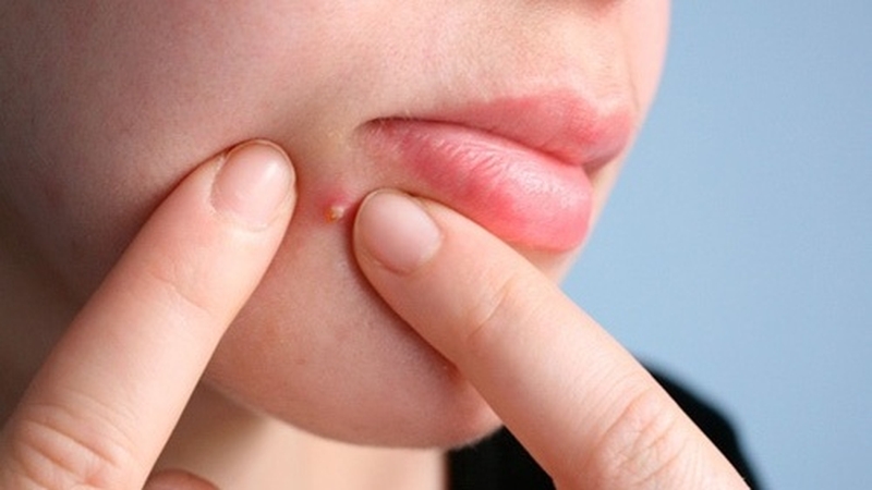 Cách trị mụn nhọt ở mặt và những lưu ý khi điều trị tại nhà 2