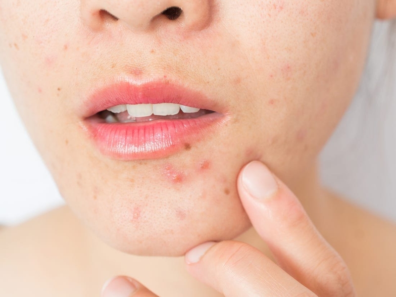 Cách trị mụn nội tiết ở cằm hiệu quả -3