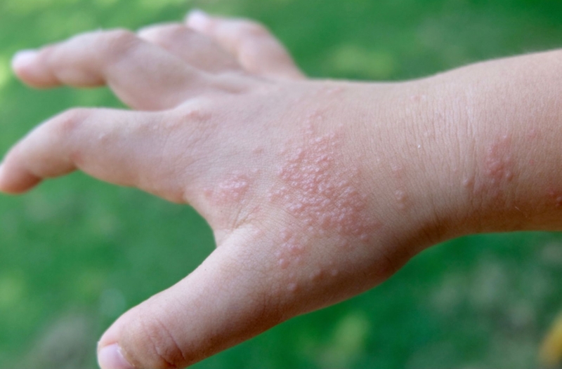 Tìm hiểu nguyên nhân và cách trị mụn nước hiệu quả 1