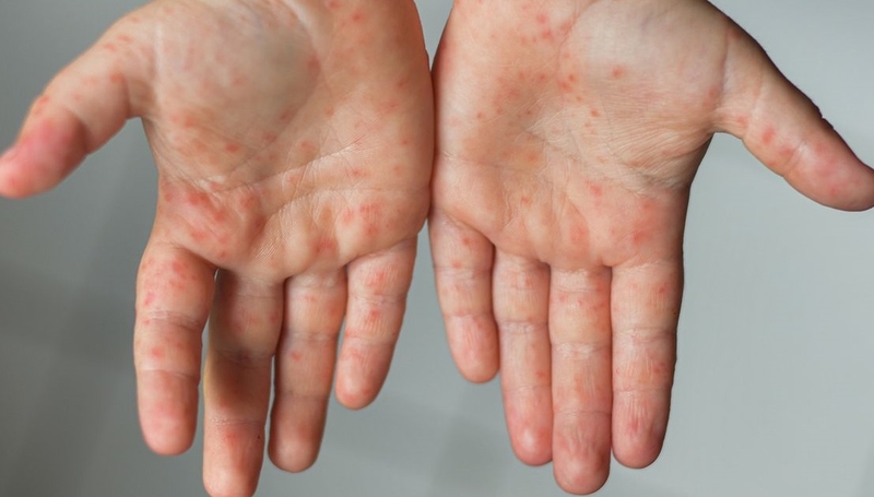 Tìm hiểu nguyên nhân và cách trị mụn nước hiệu quả 2