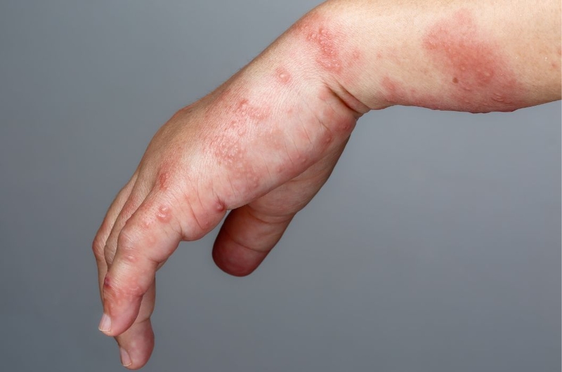 Tìm hiểu nguyên nhân và cách trị mụn nước hiệu quả 4