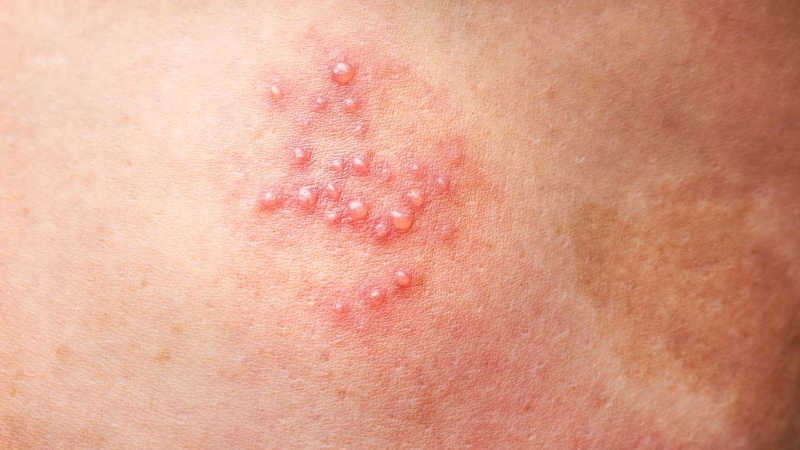 Cách trị mụn rộp sinh dục tại nhà có hiệu quả không? 1