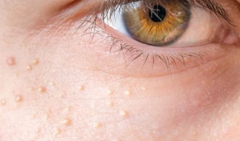 Cách trị mụn thịt ở mắt bằng dân gian an toàn và dễ thực hiện 1
