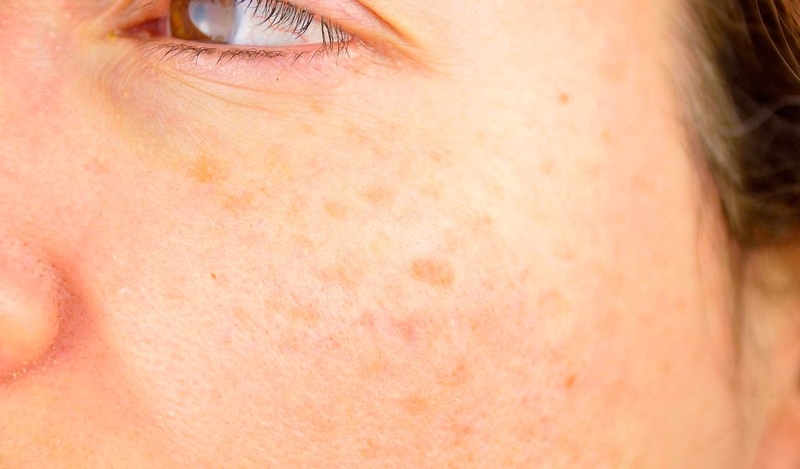 Cách trị nám bằng dầu gấc dễ thực hiện không nên bỏ quả 1