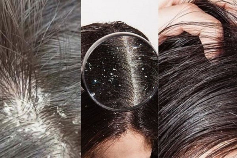 cách trị nấm da đầu dân gian hiệu quả