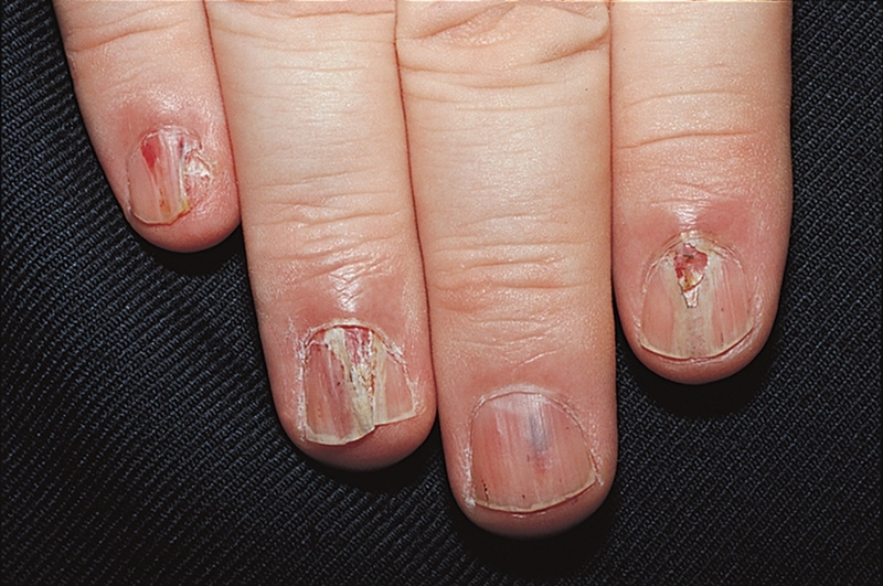 Cách trị nấm móng tay dứt điểm an toàn và hiệu quả 2