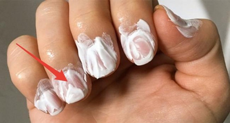 Cách trị nấm móng tay dứt điểm an toàn và hiệu quả 3