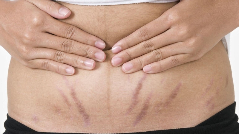 Cách trị rạn da đỏ khi tăng cân 1