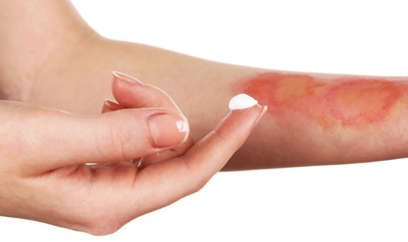 Cách trị sẹo bỏng bằng nghệ tươi liền da, xóa sẹo thâm 2