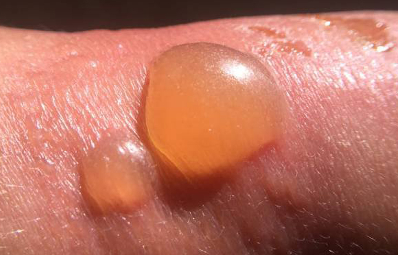 Cách trị sẹo bỏng từ nguyên liệu thiên nhiên lành tính 1