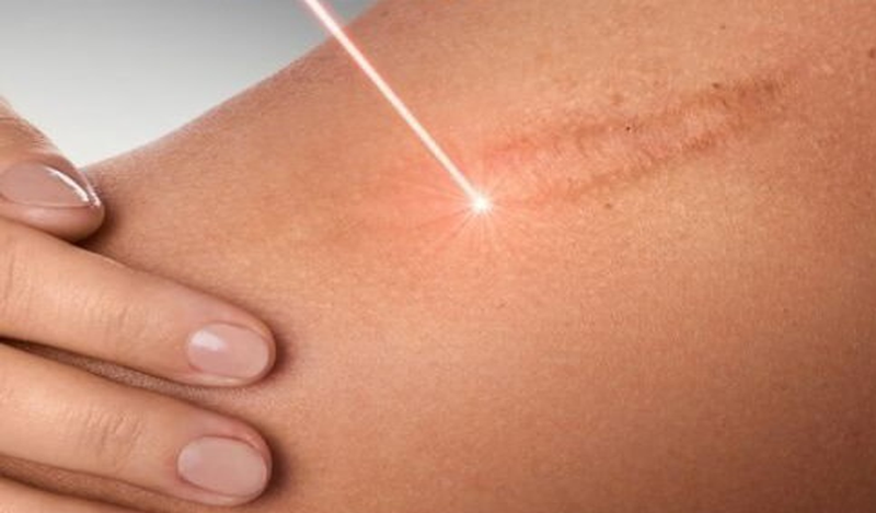 Xóa sẹo thâm bằng phương pháp laser