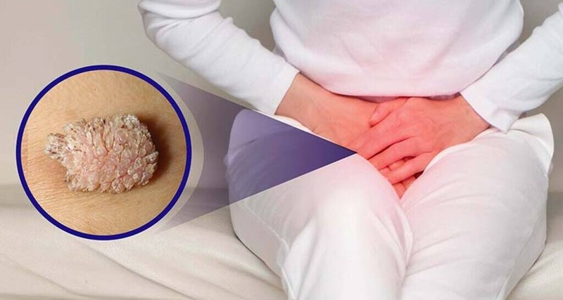 Cách trị sùi mào gà ở nữ và các biện pháp phòng ngừa bệnh sùi mào gà 1