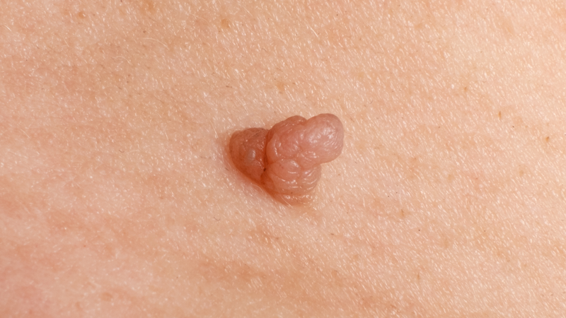 Cách trị sùi mào gà ở nữ và các biện pháp phòng ngừa bệnh sùi mào gà 3