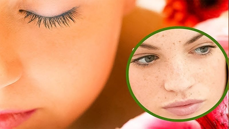 Cách trị tàn nhang đồi mồi trên mặt