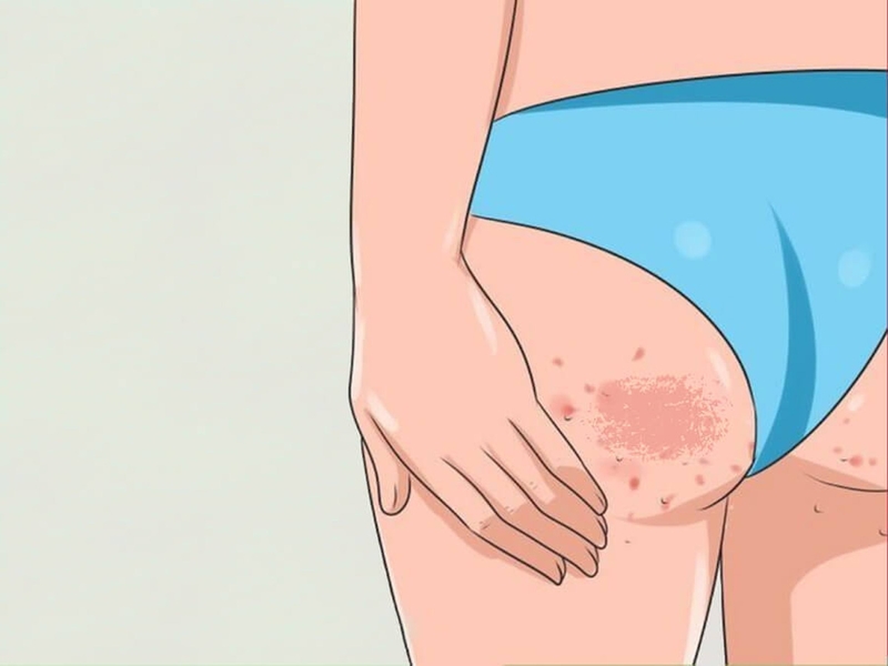 cách trị thâm mông cấp tốc 1