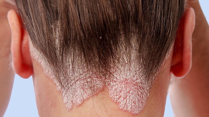 Cách trị vảy nến da đầu tại nhà và những sai lầm cần tránh 1