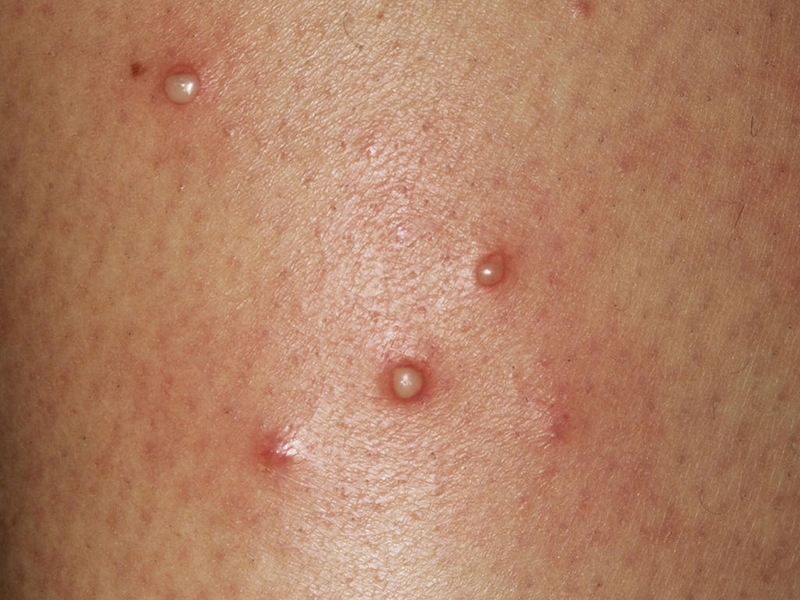 Cách trị viêm nang lông bằng lá trầu không2