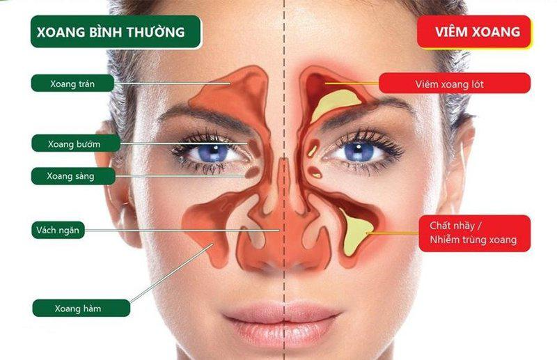 Thực hư cách trị viêm xoang bằng rượu và muối? 1