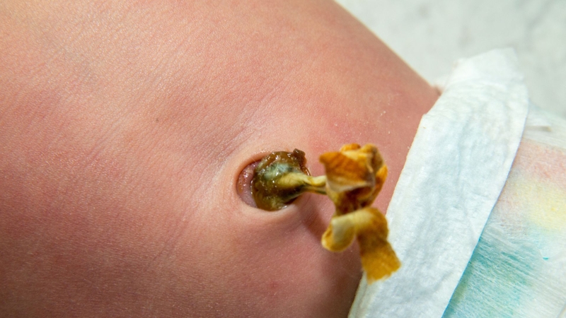 Cách vệ sinh rốn khi bị nhiễm trùng cần sự nhẹ nhàng, dùng dung dịch phù hợp, giữ khô