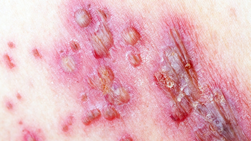 Cách vệ sinh vết zona thần kinh và biện pháp phòng ngừa bệnh zona thần kinh hiệu quả 2