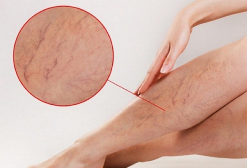 Cách xoa bóp chân bị giãn tĩnh mạch tại nhà hiệu quả, an toàn, dễ thực hiện 4