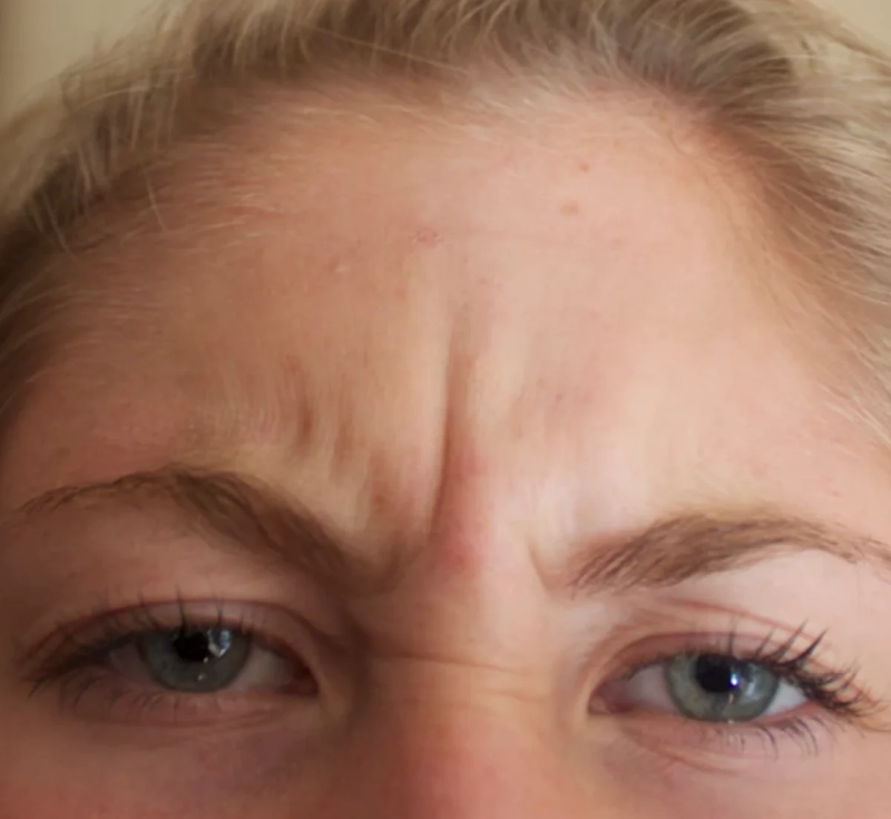 Nguyên nhân gây nếp nhăn sống mũi và cách khắc phục tình trạng này 1