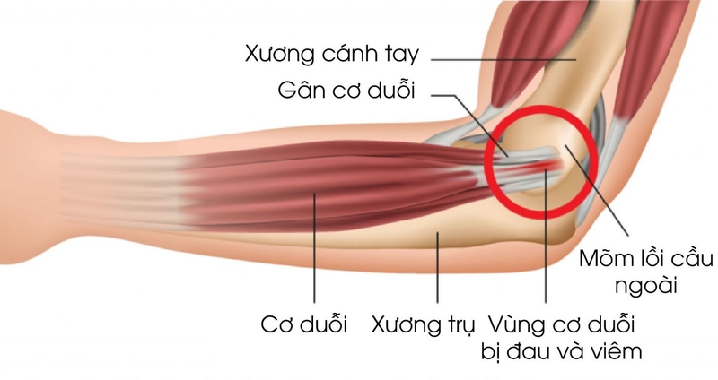 Cách xóa tan nỗi lo đau khuỷu tay khi chơi tennis 2