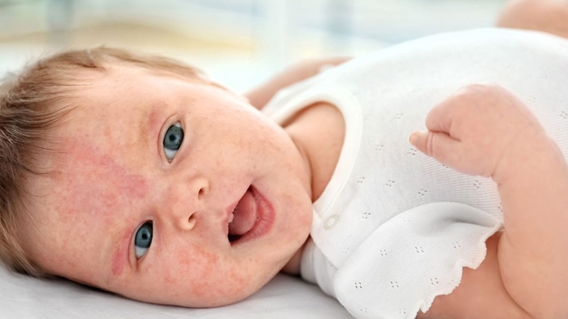 Cách xử lý bệnh chàm bội nhiễm ở trẻ em 2