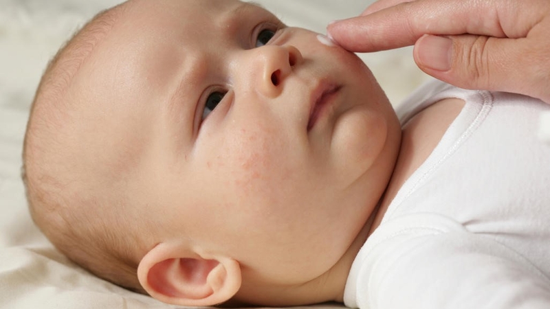Cách xử lý bệnh chàm bội nhiễm ở trẻ em 3