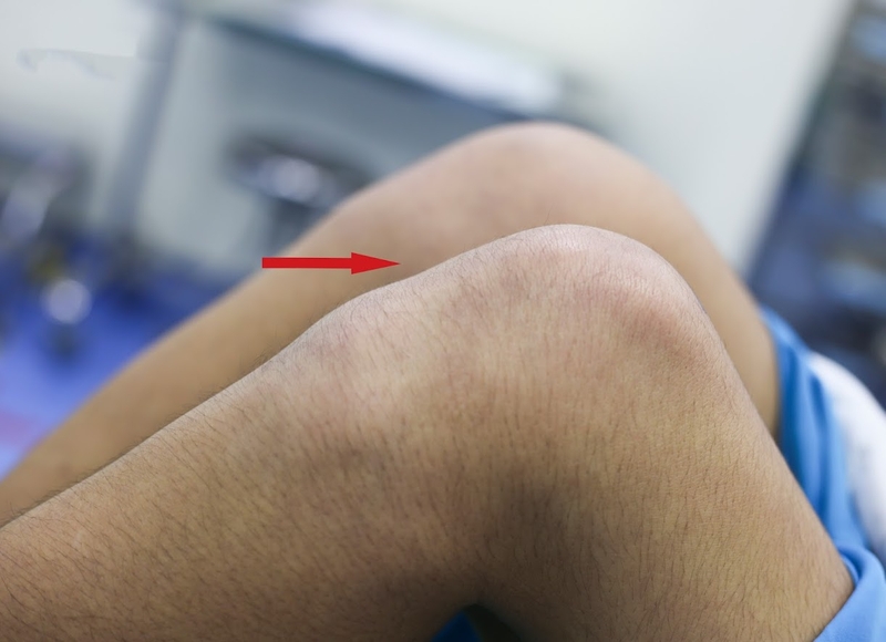 Trật khớp làm da vùng khớp thường bị bầm tím, sưng và có cảm giác đau, cứng khớp