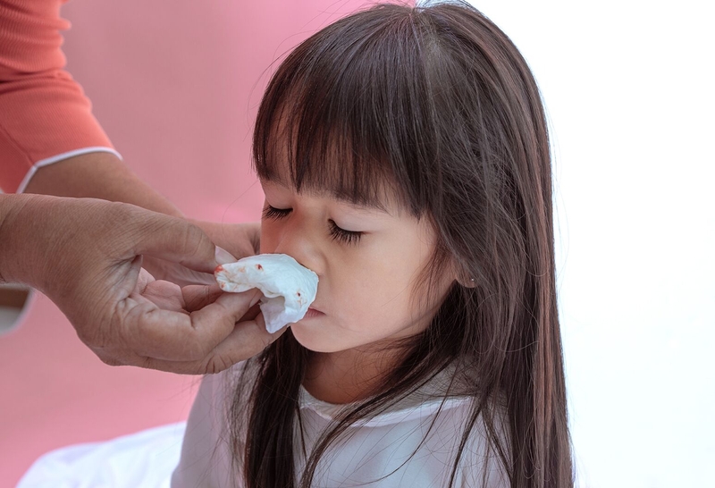 Cách xử lý khi trẻ bị chảy máu cam mà bố mẹ cần biết 2