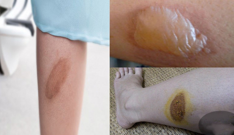 cach-xu-ly-khi-vet-bong-bo-xe-may-bi-phong 1.jpg