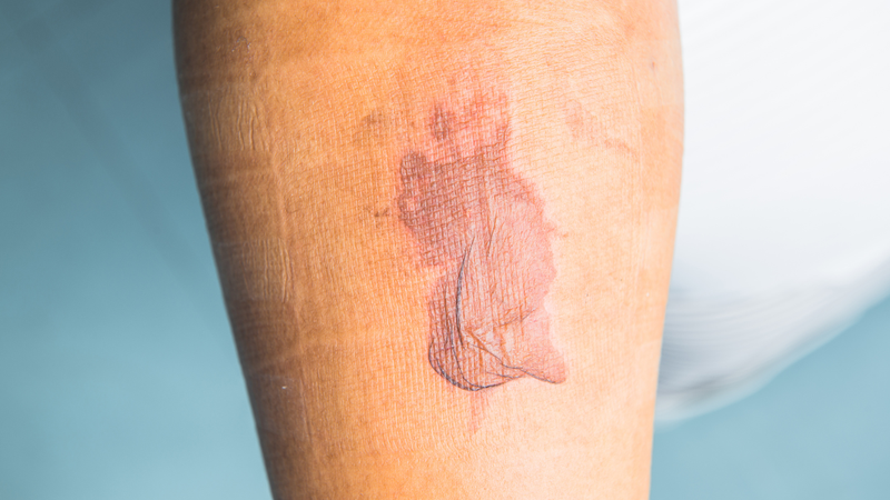 cach-xu-ly-khi-vet-bong-bo-xe-may-bi-phong 2.png