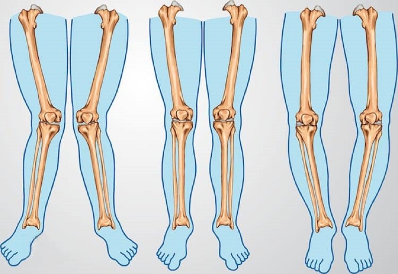 Cải thiện tình trạng chân cong ra sau bằng cách nào 1