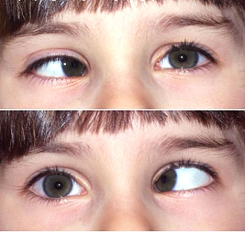 Cảm cúm mắt đỏ, triệu chứng nguy hiểm của bệnh cảm cúm 2