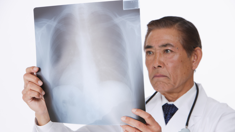 Chụp X-quang ngực giúp chẩn đoán nguyên nhân gây ra bệnh