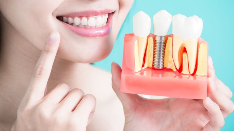 Cắm implant có niềng răng được không? Cần lưu ý gì? 1