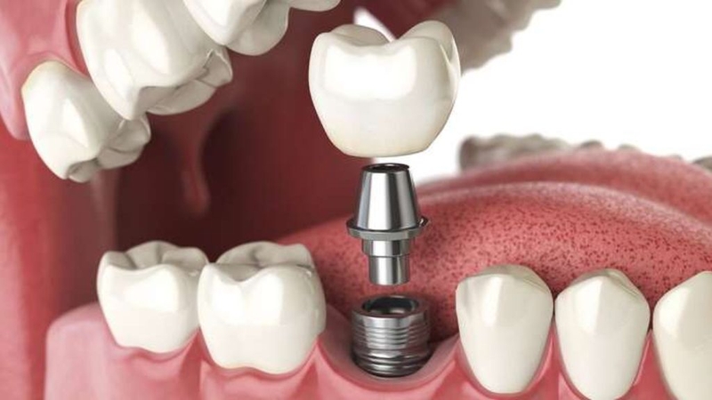 Cắm implant là gì? Có nên thực hiện hay không?  1