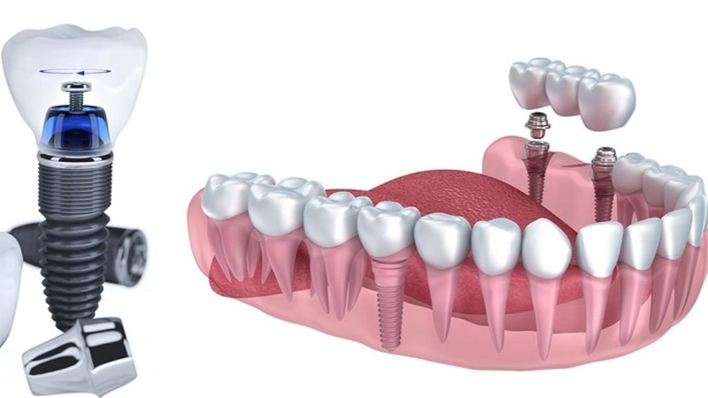 Cắm implant là gì? Có nên thực hiện hay không? 2